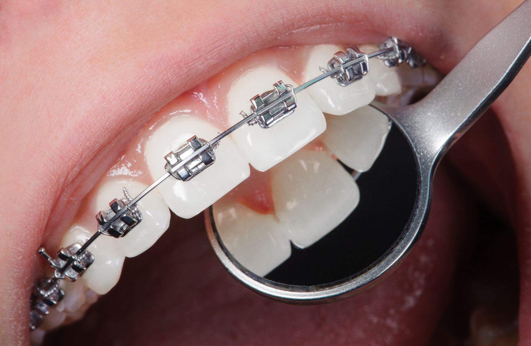 Close-up of metal braces and a dental mirror